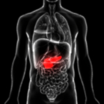 Kolecystit (inflammation i gallblåsan)